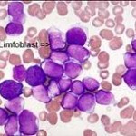 Leukemia limfositik akut 