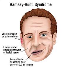 Sindrom Ramsay Hunt 