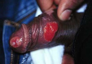 Gambaran Klinis Penyakit Granuloma Inguinale 
