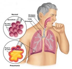 askep bronkopneumonia