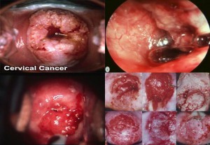 Asuhan Keperawatan Tumor uterus