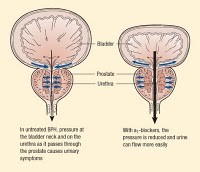  Asuhan Keperawatan BPH (Benigna Prostat Hiperlasia)