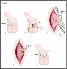 Pemasangan Kontrasepsi Vasektomi dan Tubektomi
