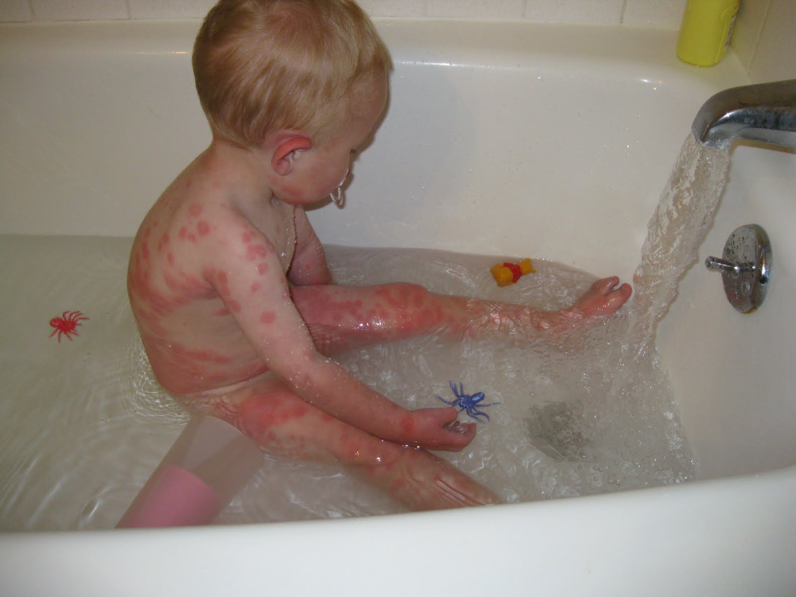 После купания болят. Аллергия симптомы на коже у ребенка.