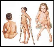 Penyakit Saraf Poliomielitis atau Polio
