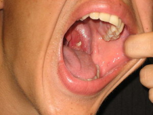 Ciri-Ciri Terkena Kanker Tonsil